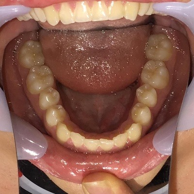 症例集　インビザライン　下顎