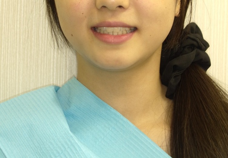 症例集　インビザライン　笑顔