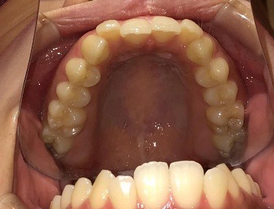 症例集　インビザライン　上顎