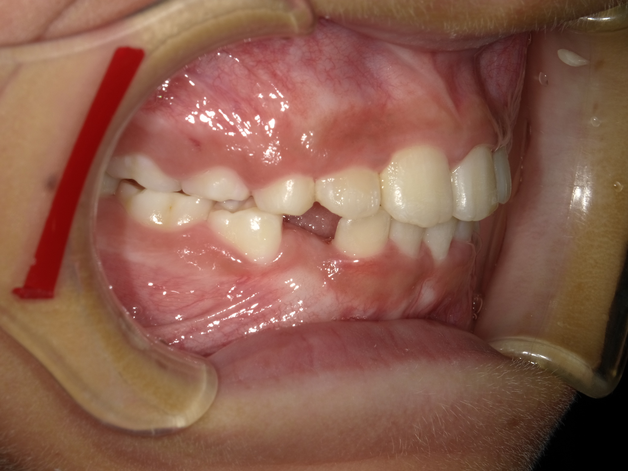 症例集　インビザライン　右横