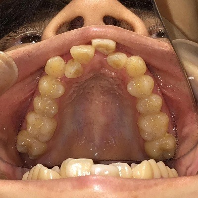 症例集　インビザライン　上顎