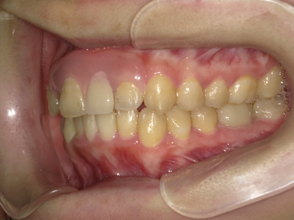 症例集　インビザライン　左横