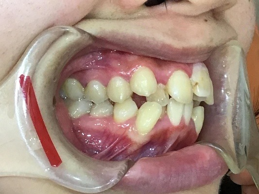 症例集　インビザライン　右横