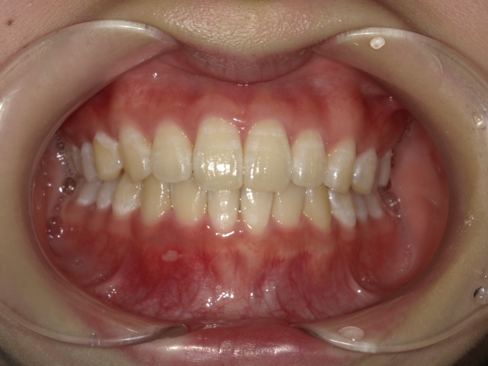 症例集　インビザライン　正面