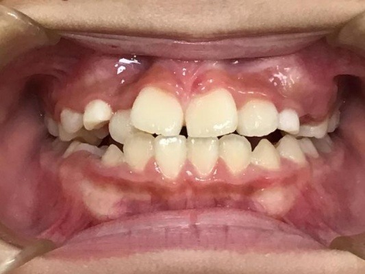 症例集　インビザライン　正面