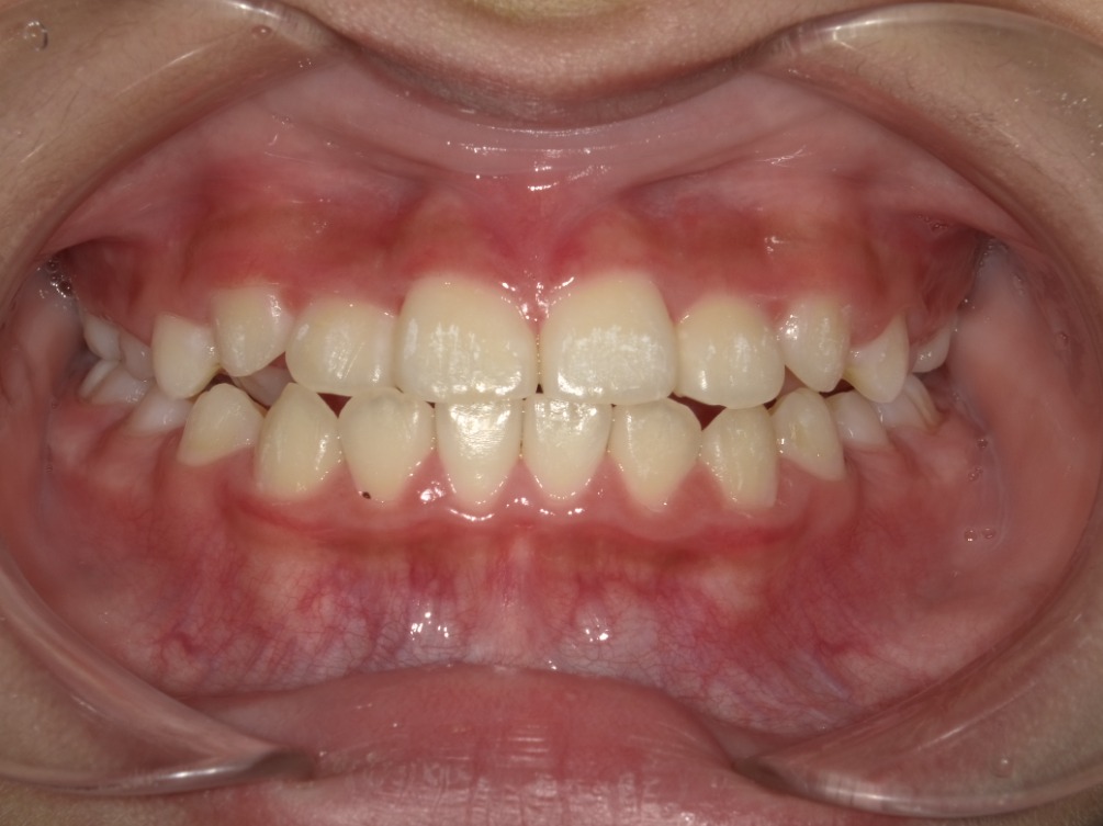 症例集　インビザライン　正面