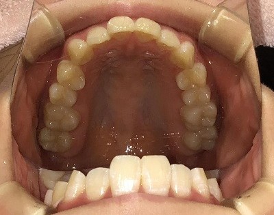 症例集　インビザライン　上顎