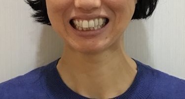 症例集　インビザライン　笑顔