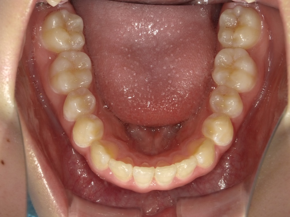 症例集　インビザライン　下顎