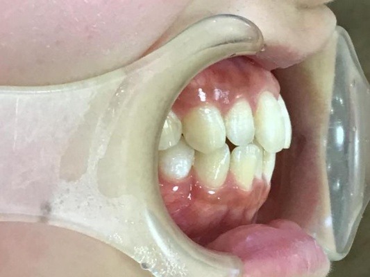 症例集　インビザライン　右横