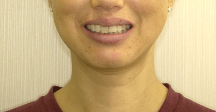 症例集　インビザライン　笑顔