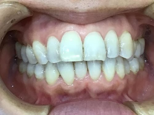 症例集　インビザライン　正面