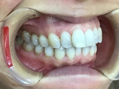 症例集　インビザライン　右横