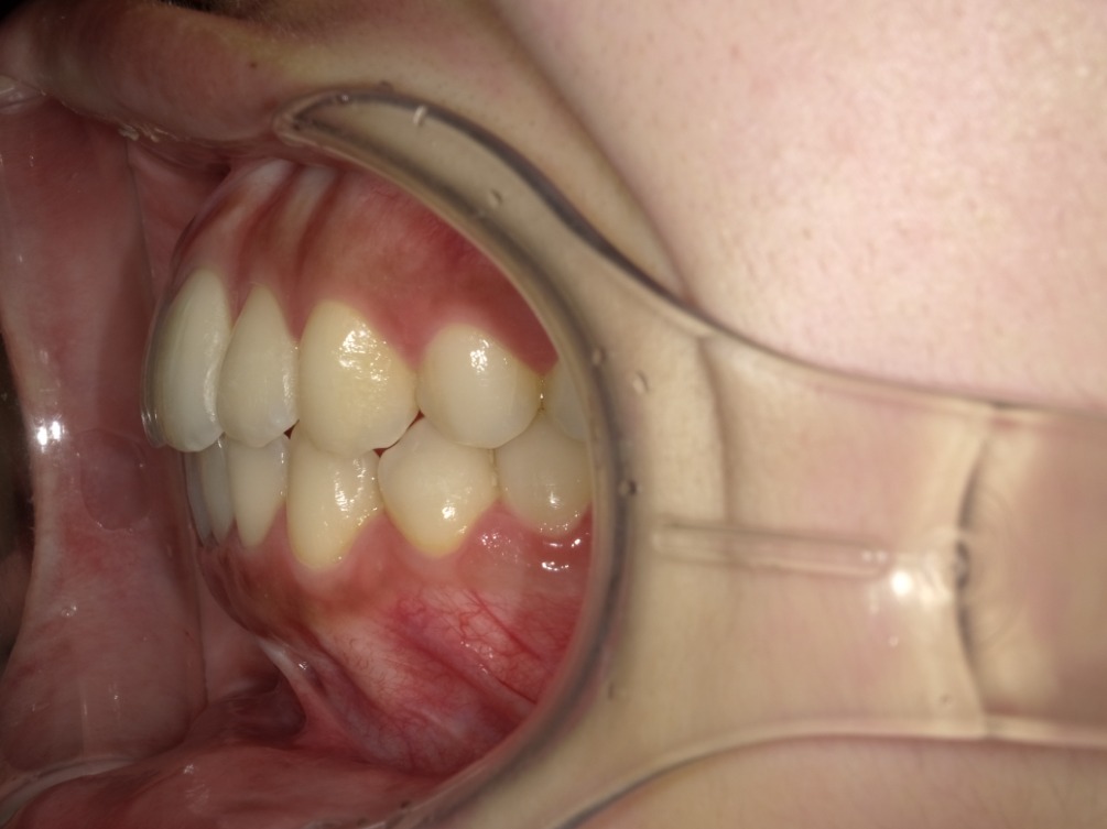 症例集　インビザライン　左横