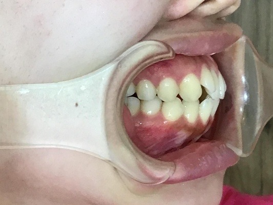 症例集 インビザライン 右横