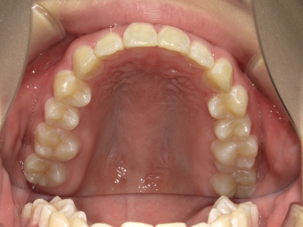 症例集　インビザライン　上顎