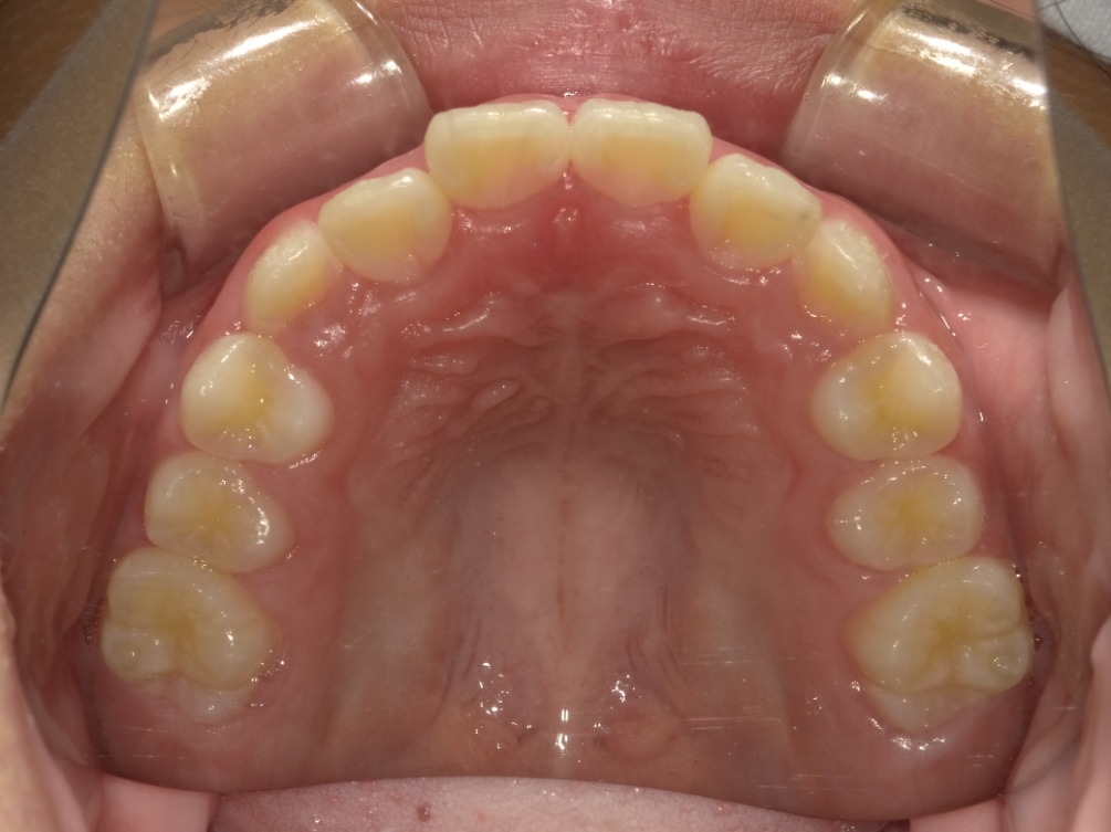 症例集　インビザライン　上顎