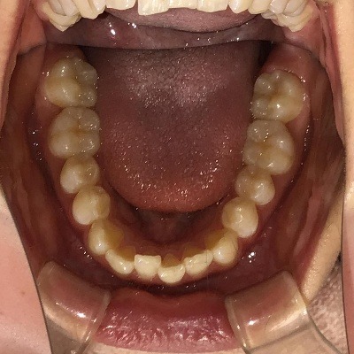 症例集　インビザライン　下顎