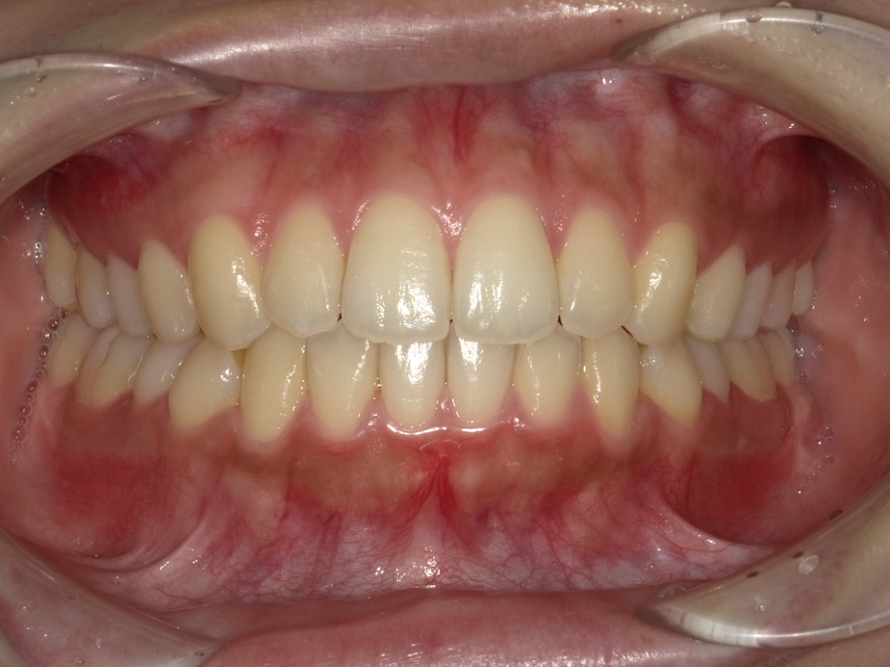 症例集　インビザライン　正面