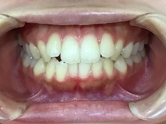 症例集　インビザライン　正面