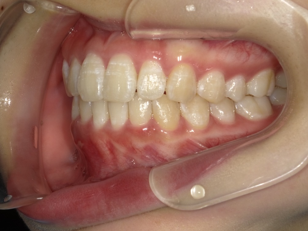 症例集　インビザライン　左横