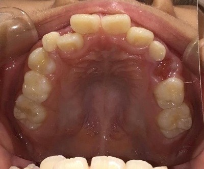 症例集　インビザライン　上顎