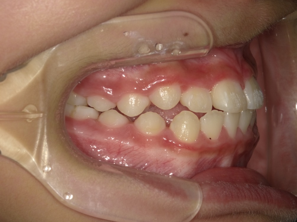 症例集　インビザライン　右横