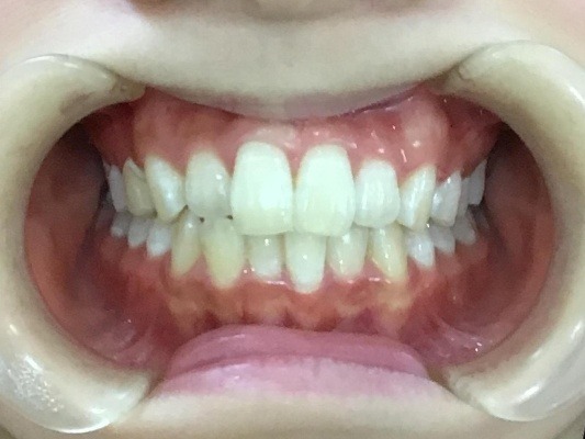 症例集　インビザライン　正面