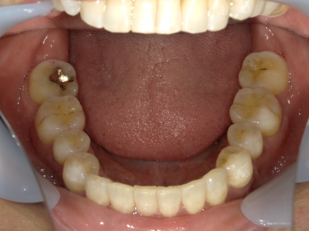 症例集　インビザライン　下顎