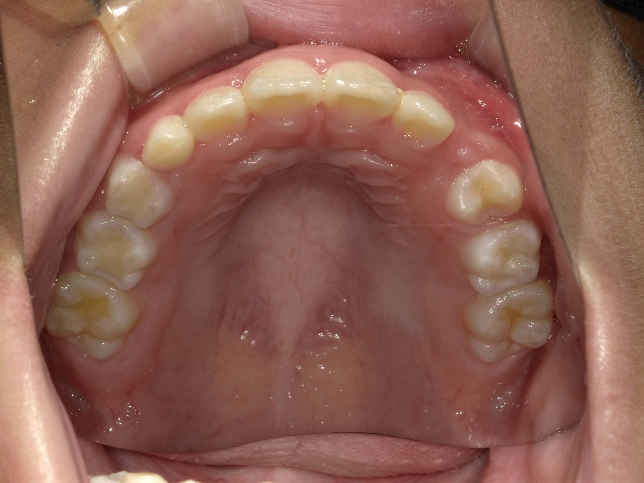 症例集 インビザライン 上顎