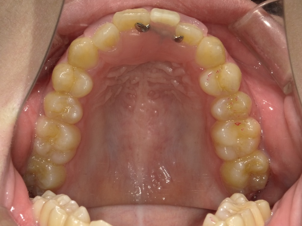 症例集　インビザライン　上顎