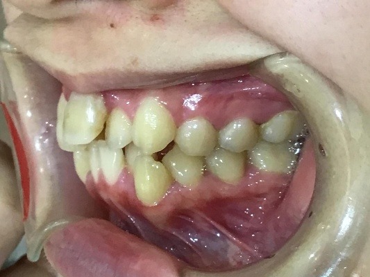 症例集　インビザライン　左横