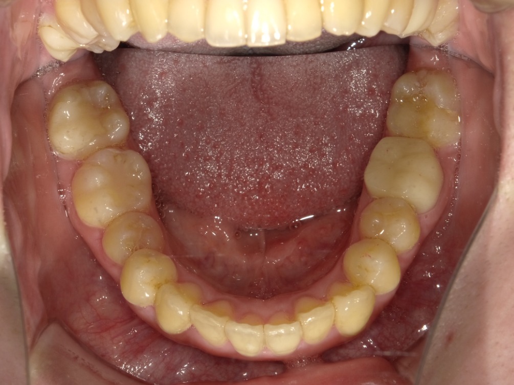 症例集　インビザライン　下顎