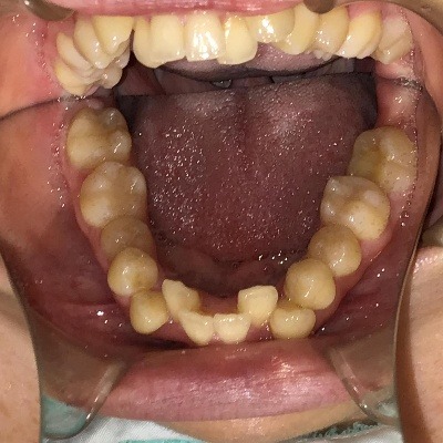 症例集　インビザライン　下顎