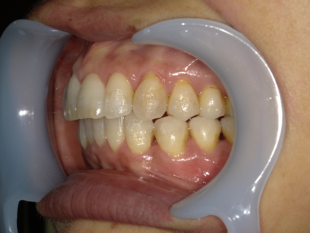 症例集　インビザライン　左横