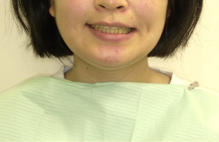 症例集　インビザライン　笑顔