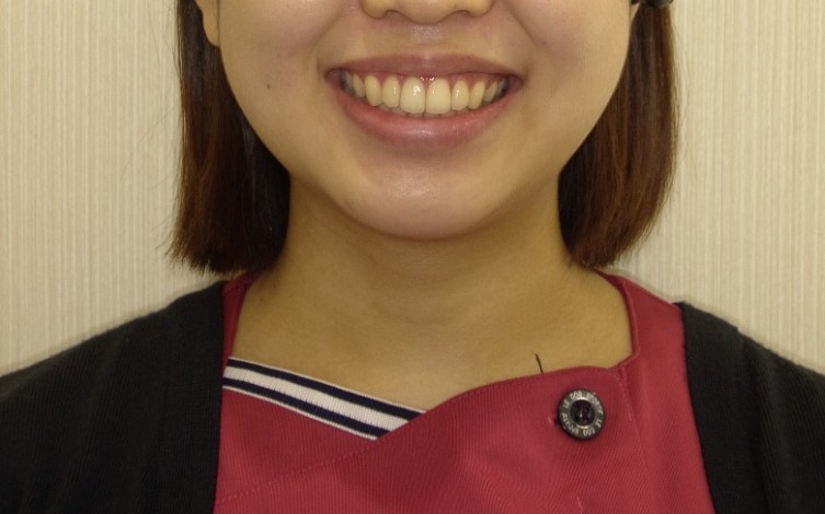 症例集　インビザライン　笑顔