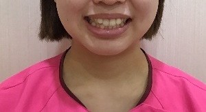 症例集　インビザライン　笑顔