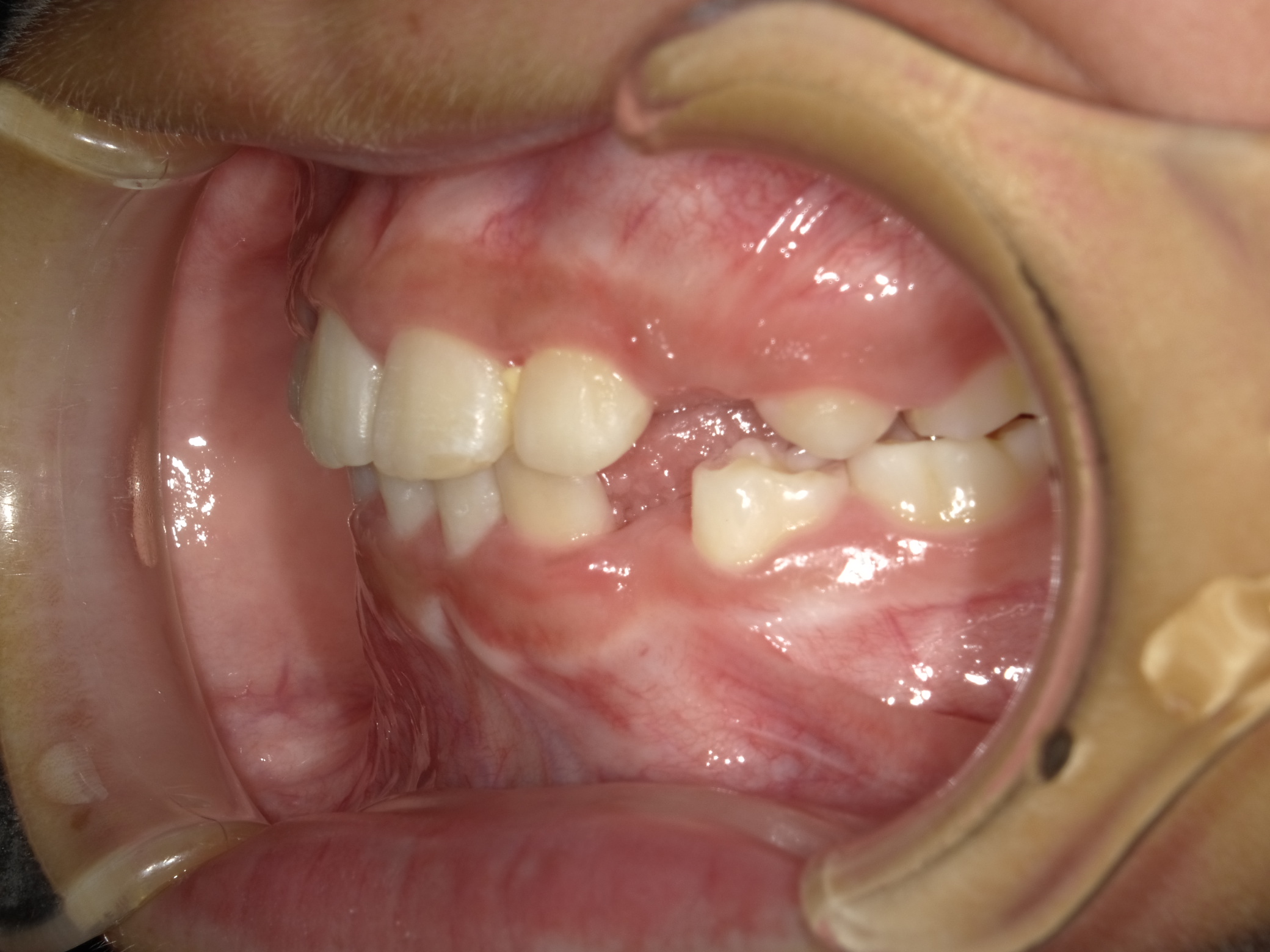 症例集 インビザライン 左横