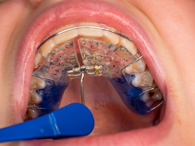 出っ歯を治すために床矯正の装置を上顎に装着しているイメージ