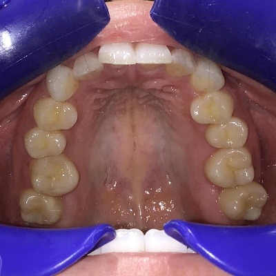 症例集　インビザライン　上顎