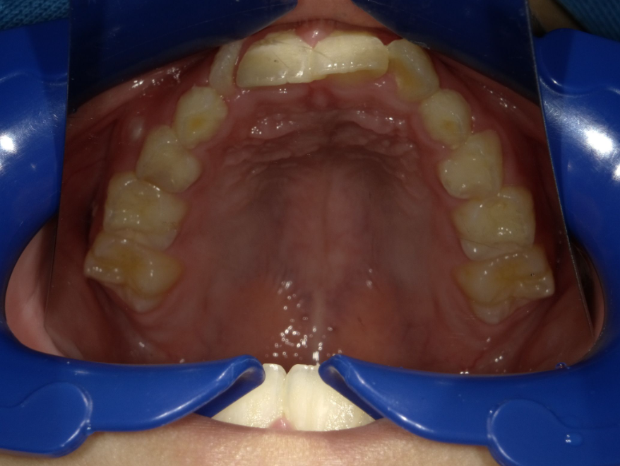 症例集　インビザライン　上顎