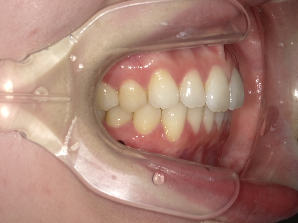 症例集　インビザライン　右横