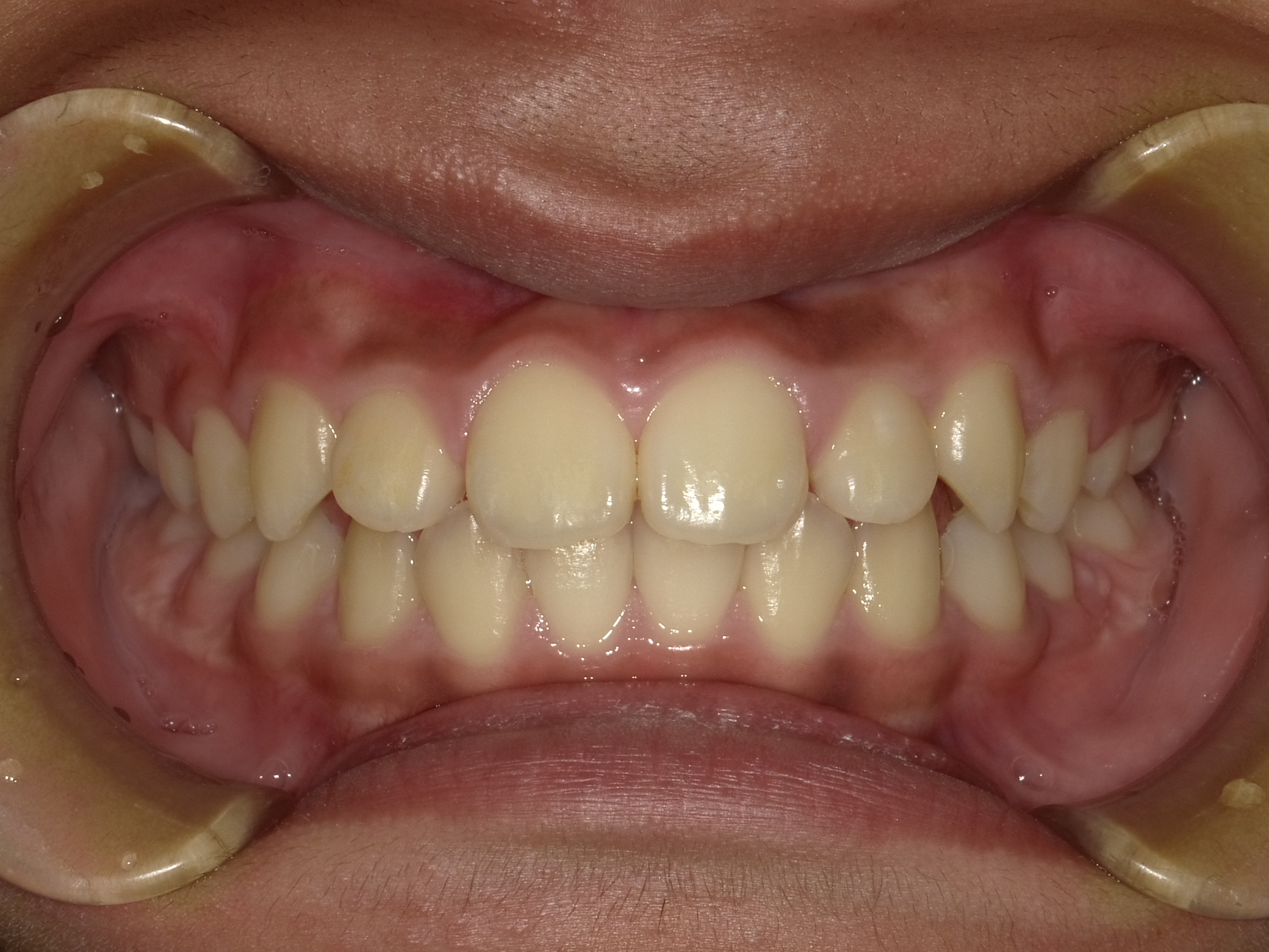 症例集　予防矯正　正面