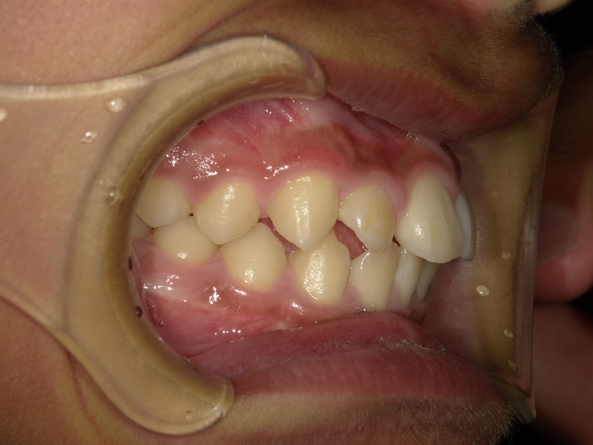 症例集　予防矯正　右横