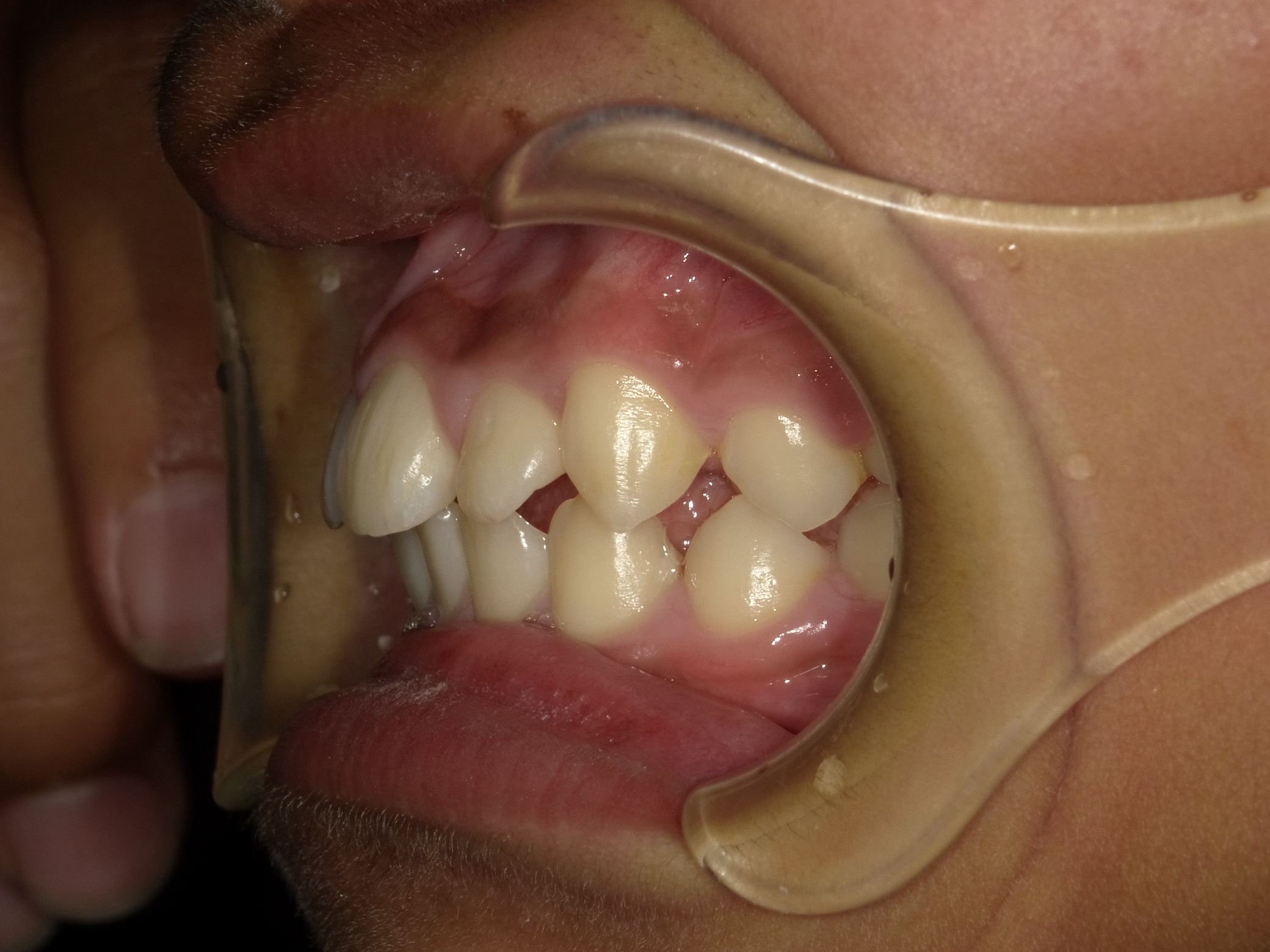 症例集　予防矯正　左横