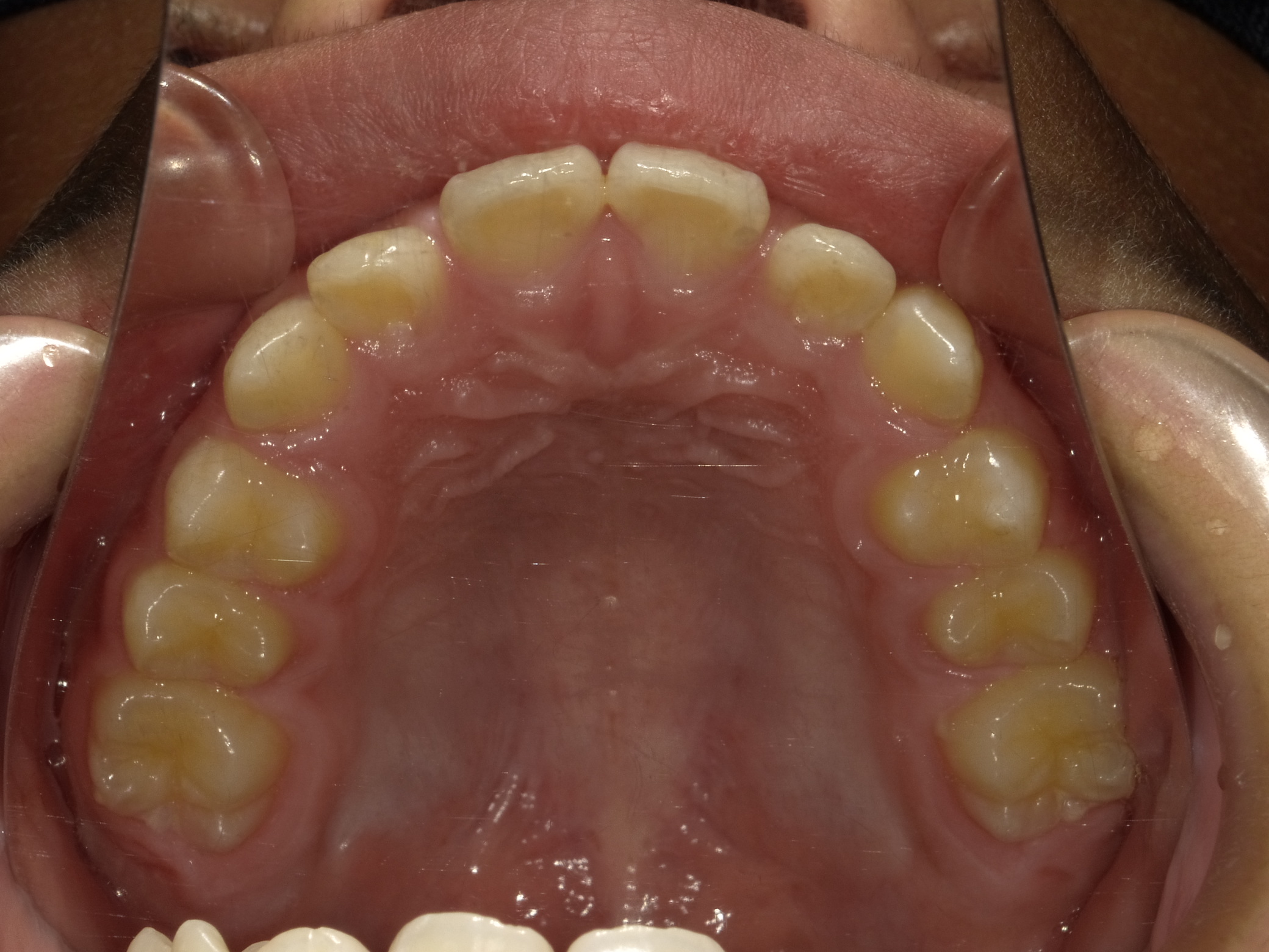 症例集　予防矯正　上顎