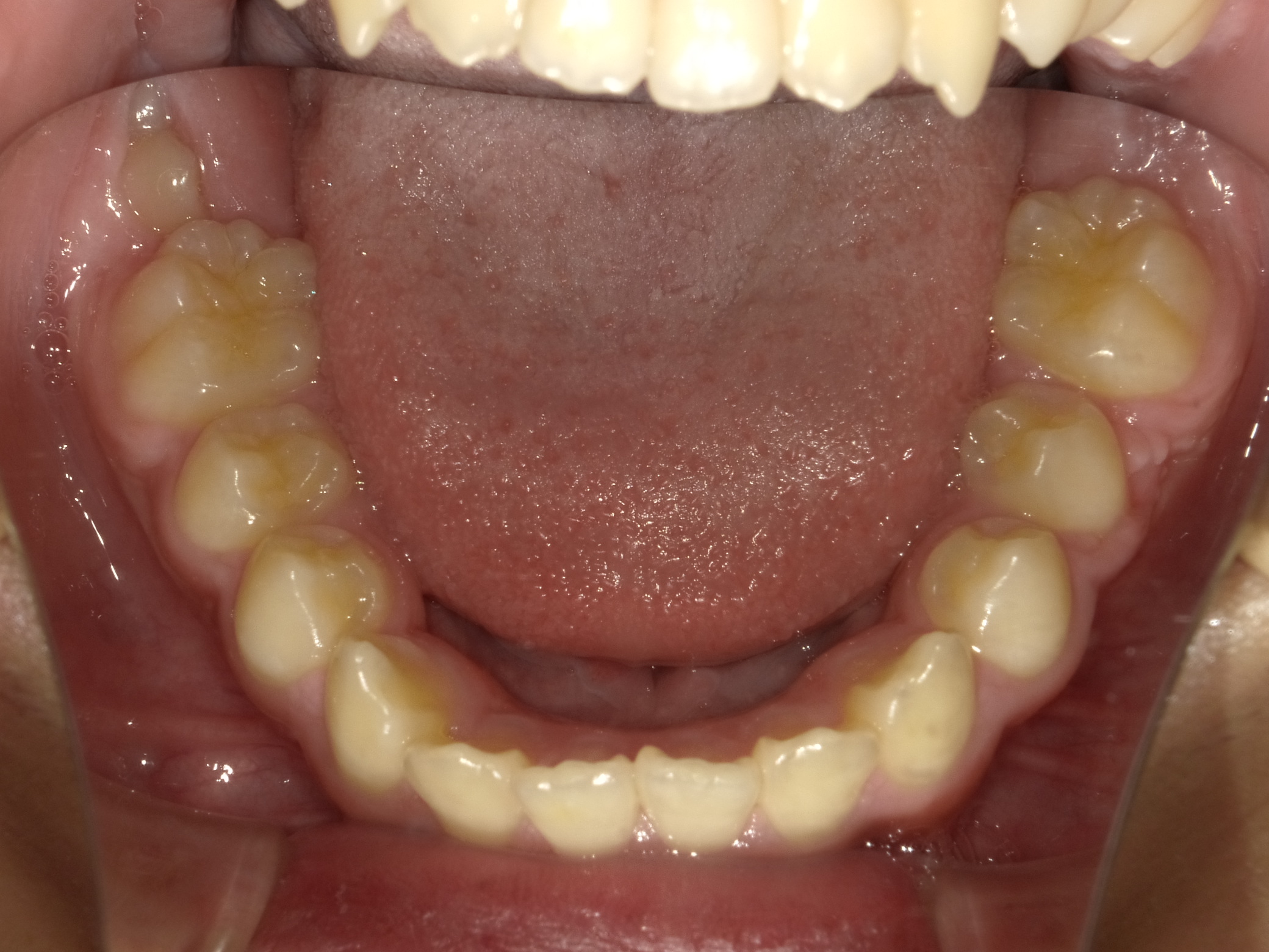 症例集　予防矯正　下顎