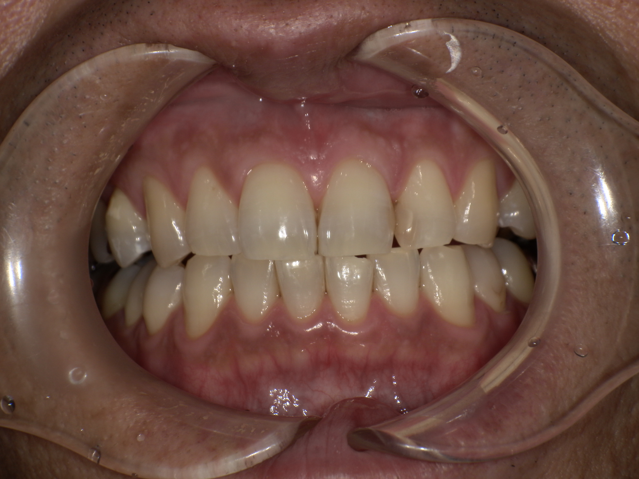 症例集　ホワイトニング　オフィス