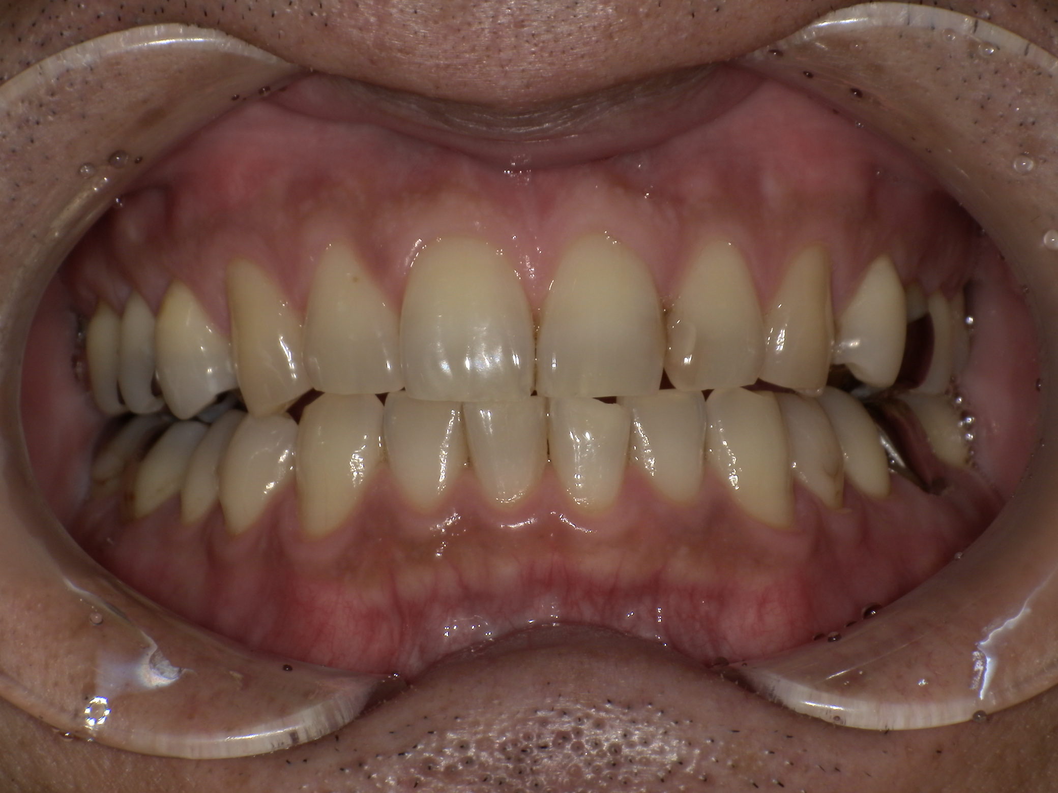 症例集　ホワイトニング　オフィス